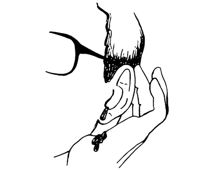 Wound