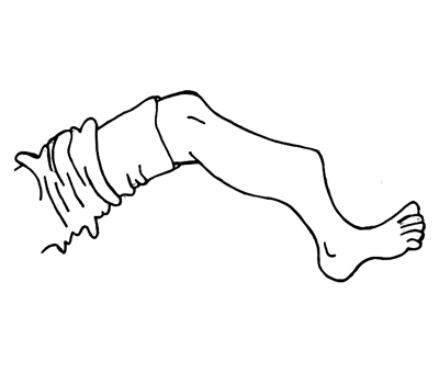 Wound