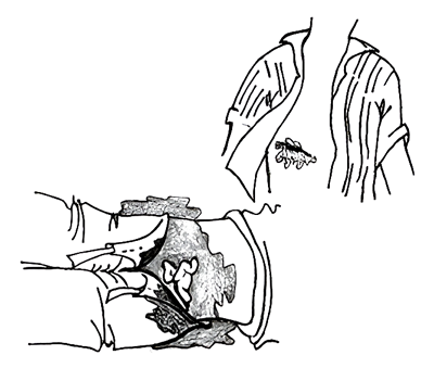Wound